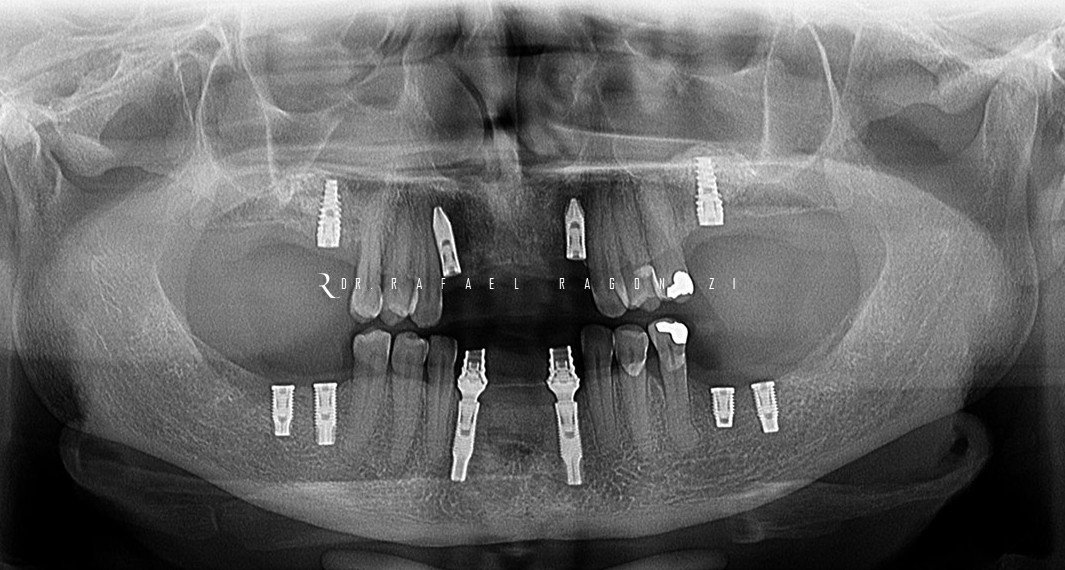 Implantes Unitários e Parciais