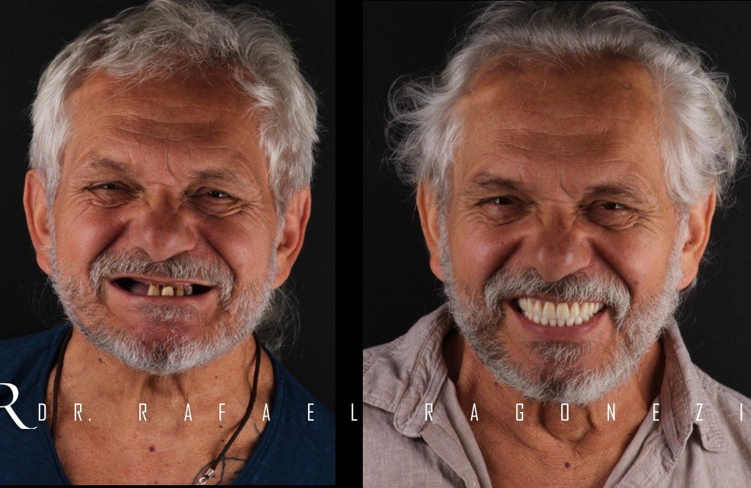 Prótese Protocolo