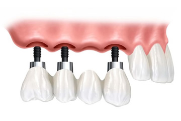 Implantes para perdas unitárias e parciais - Goiânia